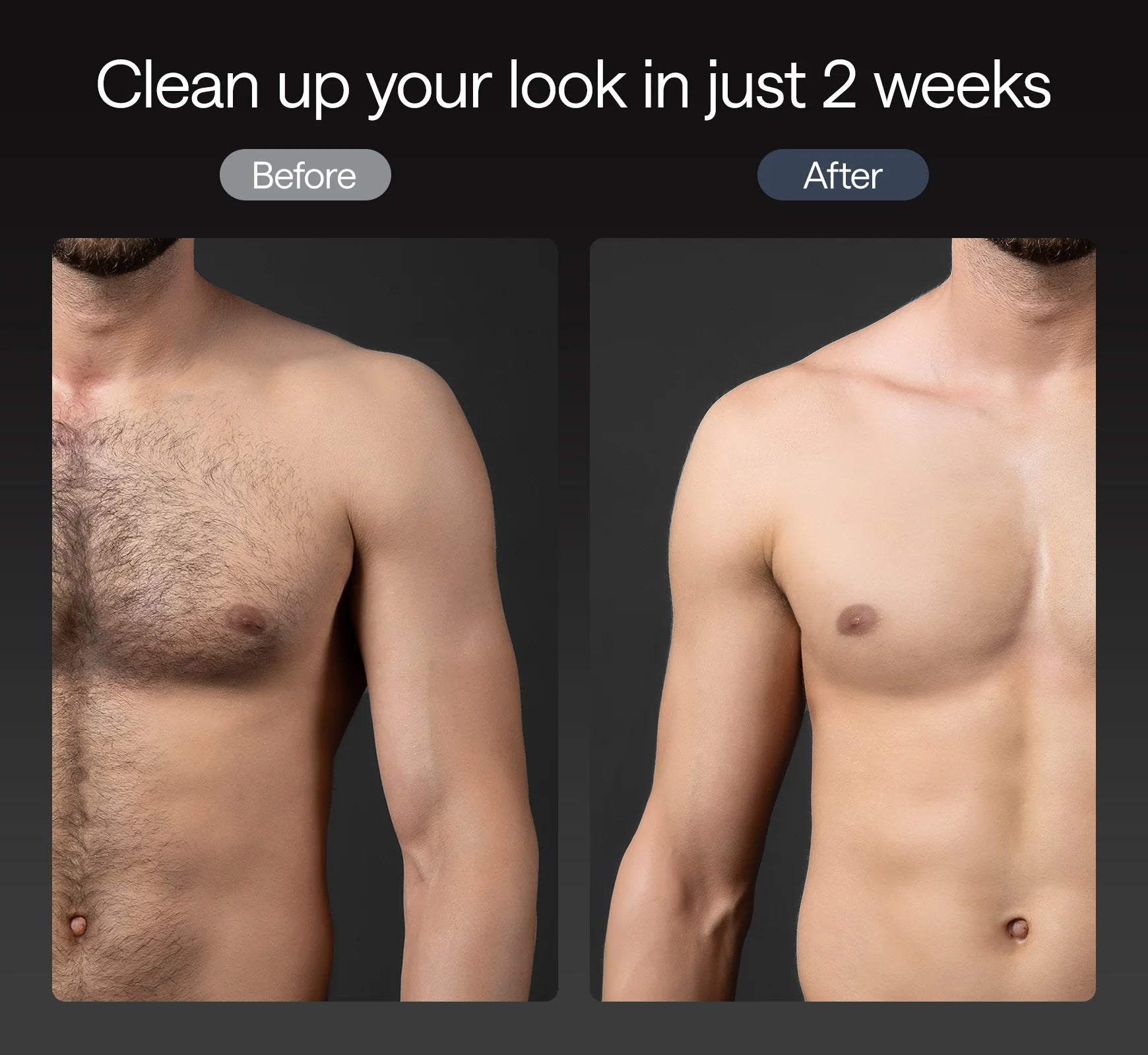 Ulike X - Depilador IPL Luz Pulsada